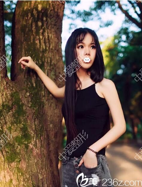 隨州奧萊院長自體脂肪填充太陽穴+額頭效果怎么樣？看我真人案例