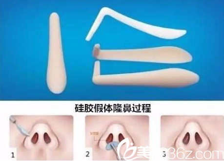 長(zhǎng)春隆鼻手術(shù)哪好？長(zhǎng)春卓研假體隆鼻8900元就能讓你擁有小翹鼻