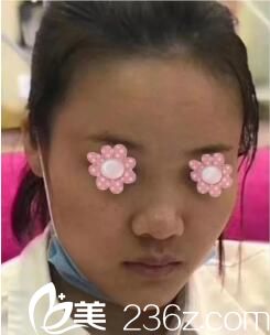 在雅美做鼻綜合術前照 在雅美做鼻綜合術前照