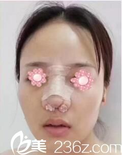 長沙雅美鼻綜合術后天 長沙雅美鼻綜合術后天