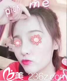 在長沙雅美做鼻綜合術后半個月 在長沙雅美做鼻綜合術后半個月