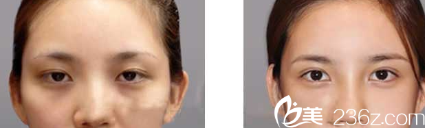 SoonPlus整形外科眼部整形案例