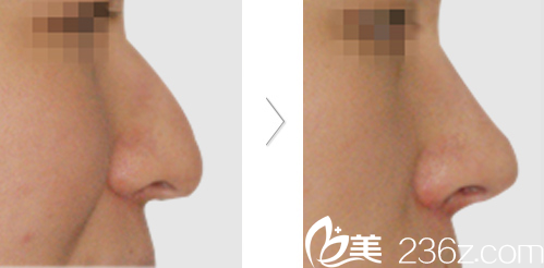 韓國SoonPlus整形外科醫(yī)院駝峰鼻矯正效果