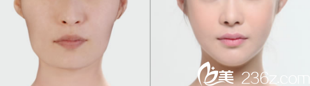 韓國SoonPlus整形外科醫(yī)院面部輪廓整形案例