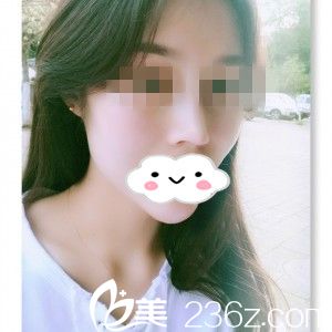 分享我在株洲華美年華做假體隆鼻+墊下巴一個多月的恢復(fù)過程