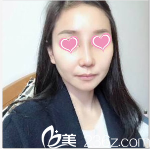 韓國SoonPlus醫(yī)院金順東鼻部整形案例術(shù)后15天樣子 韓國SoonPlus醫(yī)院金順東鼻部整形案例術(shù)后15天樣子