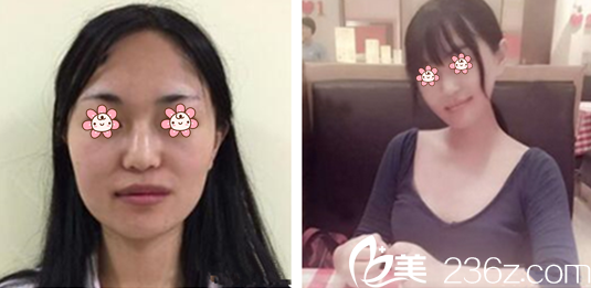 李喆遠(yuǎn)院長下頜角縮小案例 李喆遠(yuǎn)院長下頜角縮小案例