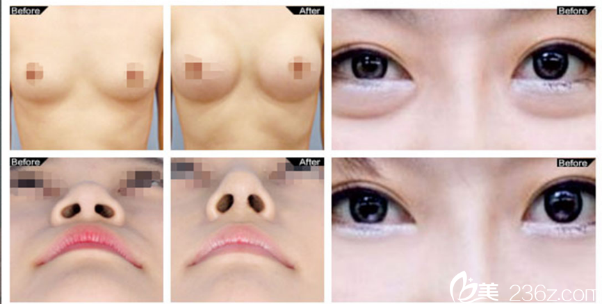 陳勇醫(yī)生整形案例 陳勇醫(yī)生整形案例