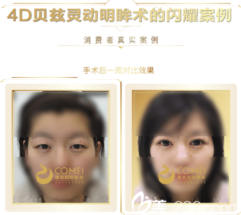 張悅迪醫(yī)生雙眼皮案例 張悅迪醫(yī)生雙眼皮案例