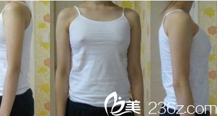 術前胸部較平 術前胸部較平