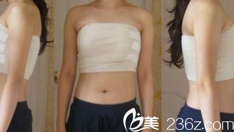 假體隆胸術后第二天恢復 假體隆胸術后第二天恢復