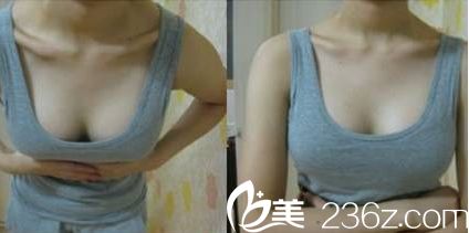 藍貝假體隆胸術后十天恢復 藍貝假體隆胸術后十天恢復