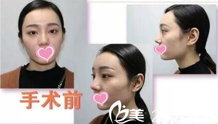 手術(shù)前照片 手術(shù)前照片