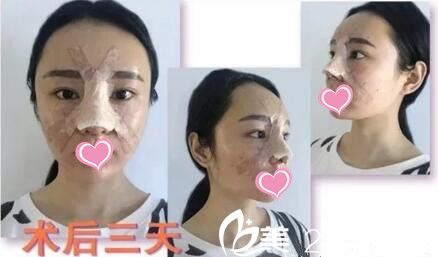 自體軟骨隆鼻第三天 自體軟骨隆鼻第三天