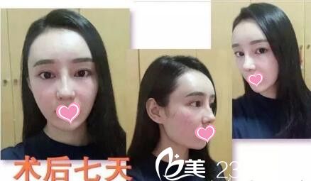 面部脂肪填充+自體軟骨隆鼻第7天 面部脂肪填充+自體軟骨隆鼻第7天