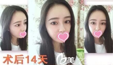 鼻整形+面部脂肪填充術(shù)后14天 鼻整形+面部脂肪填充術(shù)后14天
