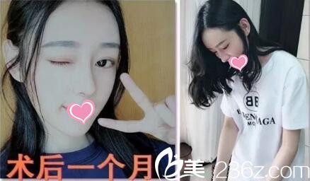 找海南韓美整形醫(yī)院彭鑫做自體軟骨隆鼻+面部自體脂肪填充1個月讓我重拾自信