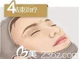 埋線提升手術(shù)第四步