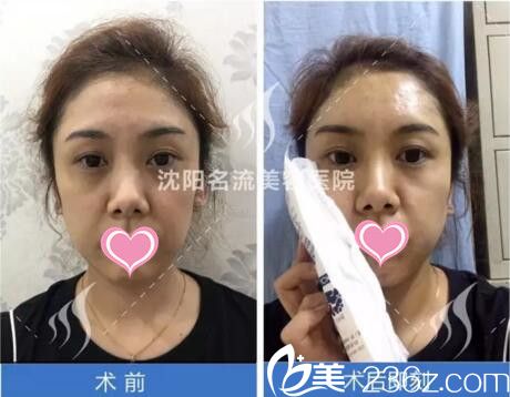 名流真人埋線提升術(shù)前術(shù)后即刻效果對比