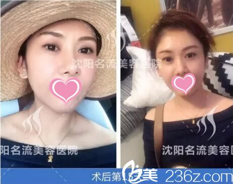 埋線提升術(shù)后半個月恢復(fù)效果