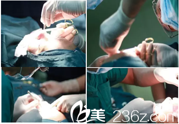 北京雅靚切開雙眼皮鼻綜合案例手術(shù)中 北京雅靚切開雙眼皮鼻綜合案例手術(shù)中