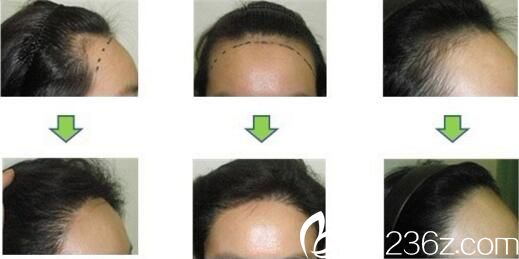 毛發(fā)移植真人前后對比 毛發(fā)移植真人前后對比