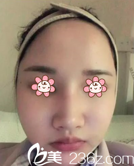 <!--<i data=20240703-sp></i>-->鳳醫(yī)生給我術后4天 <!--<i data=20240703-sp></i>-->鳳醫(yī)生給我術后4天