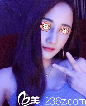 新疆黎美整形下頜角+顴弓內(nèi)推術后38天 新疆黎美整形下頜角+顴弓內(nèi)推術后38天