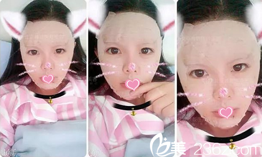 北京雅靚自體脂肪面部填充案例術(shù)后天 北京雅靚自體脂肪面部填充案例術(shù)后天