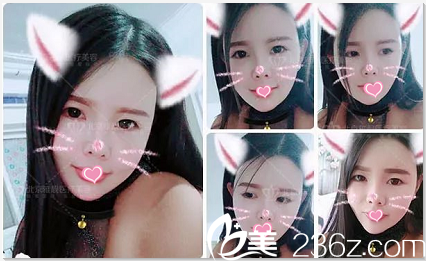 張春彥面部脂肪填充案例第14天效果 張春彥面部脂肪填充案例第14天效果