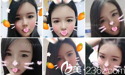 北京雅靚張春彥自體脂肪面部填充案例第46天 北京雅靚張春彥自體脂肪面部填充案例第46天