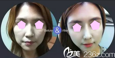 大同美神面部線雕術(shù)前術(shù)后效果對比圖