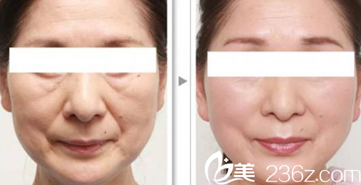 大同美神面部線雕前后效果對比圖