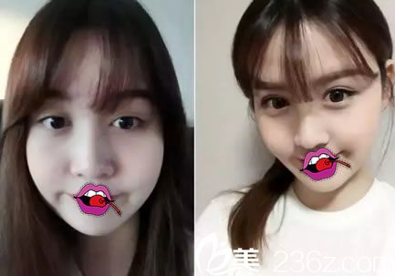 義烏陽光雙眼皮修復(fù)<span style= 義烏陽光雙眼皮修復(fù)<span style=