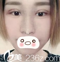 術(shù)后三天眼鼻整形恢復(fù) 術(shù)后三天眼鼻整形恢復(fù)