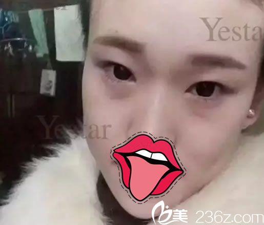 在嘉興藝星做雙眼皮手術(shù)前 在嘉興藝星做雙眼皮手術(shù)前