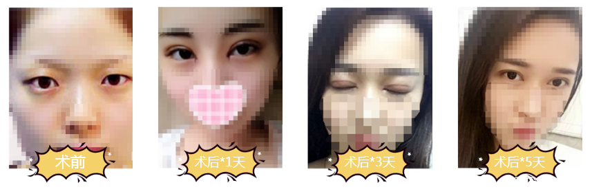 蘇州美貝爾雙眼皮整形案例