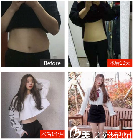 文國(guó)忠醫(yī)生吸脂案例