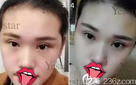 在嘉興藝星做雙眼皮7天恢復(fù)效果 在嘉興藝星做雙眼皮7天恢復(fù)效果