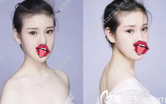 貼了兩年的雙眼皮貼后到嘉興yestar藝興整形找儲(chǔ)剛主任做了雙眼皮開眼角手術(shù)和玻尿酸填充太陽穴