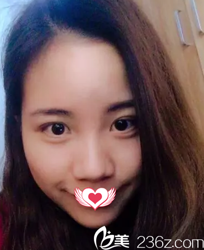 術(shù)前鼻子塌平 術(shù)前鼻子塌平