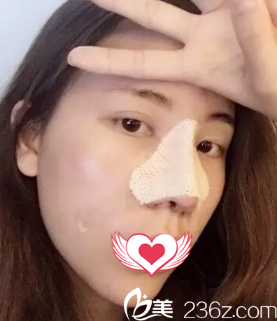 術(shù)后2天鼻子腫脹 術(shù)后2天鼻子腫脹