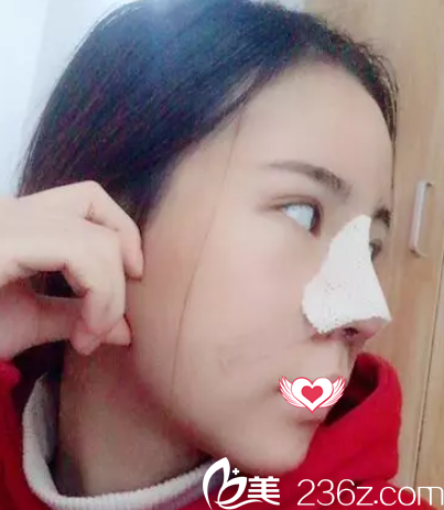 鼻綜合7天鼻子拆線后的樣子 鼻綜合7天鼻子拆線后的樣子