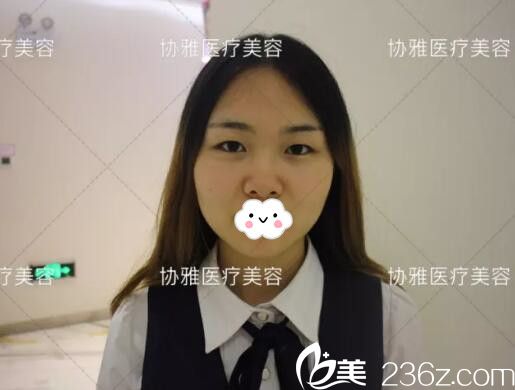 在協(xié)雅做眼鼻整形術(shù)前照 在協(xié)雅做眼鼻整形術(shù)前照