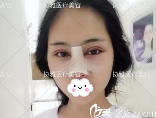 眼鼻手術(shù)后即刻術(shù)后效果 眼鼻手術(shù)后即刻術(shù)后效果