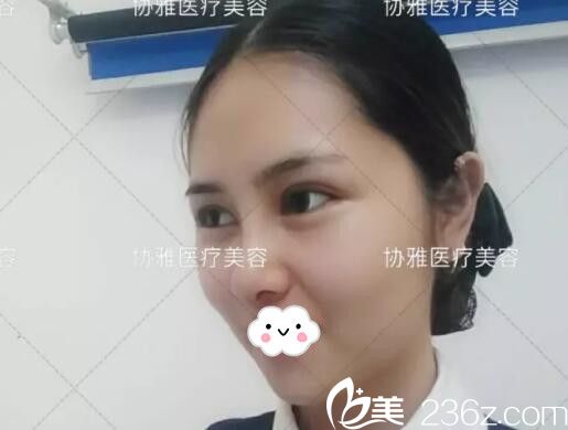 在協(xié)雅做眼鼻整形手術(shù)半個(gè)月效果 在協(xié)雅做眼鼻整形手術(shù)半個(gè)月效果