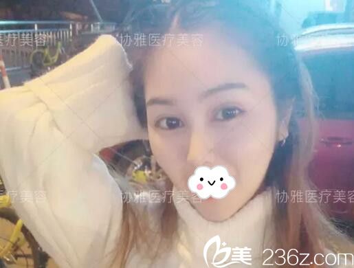 看我在長沙協(xié)雅做了雙眼皮+鼻綜合術后不到1個月恢復效果完全超乎我的想象