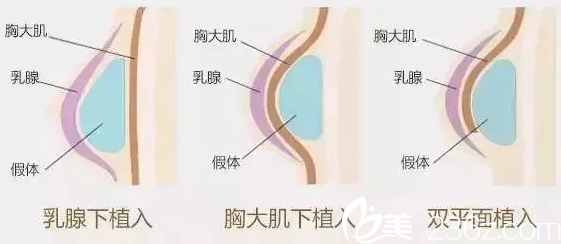 隆胸一般價(jià)格多少?南寧伊麗莎白蜜桃豐胸43000元起讓你從此乳溝不用擠