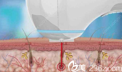 遼源澎濤激光脫毛的原理