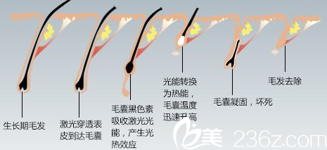 激光脫毛基本達到性
